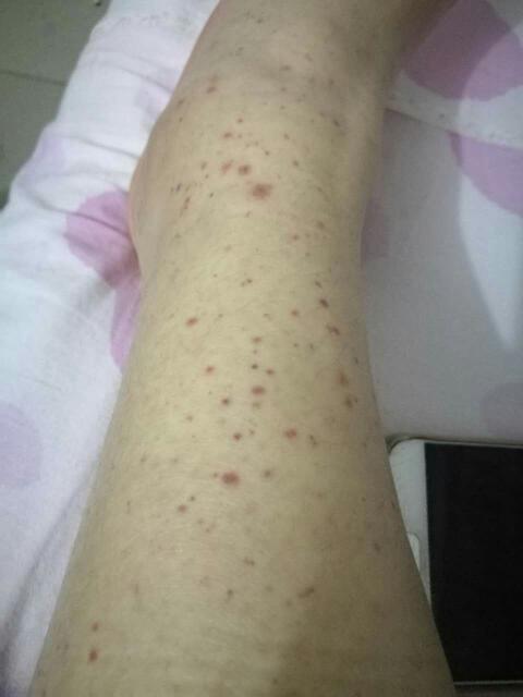 腿上出现红点,是不是因为喝酒或者经常熬夜呢,怎么预防,怎么治疗?