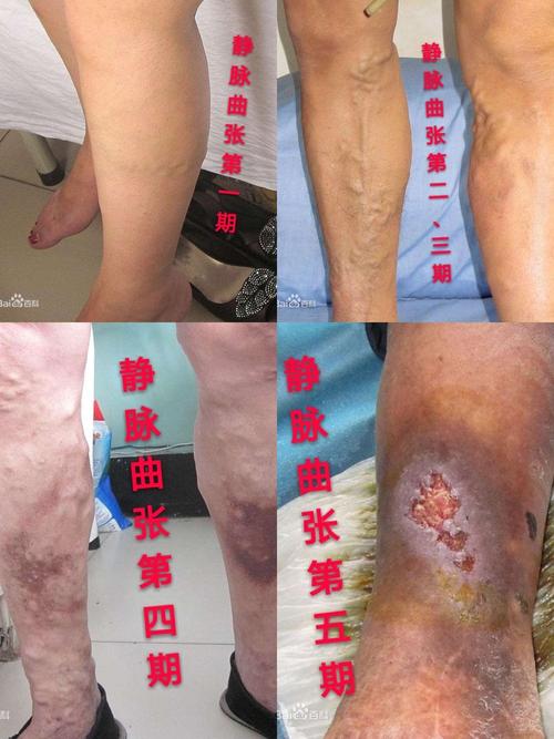 关于静脉曲张,你了解多少?