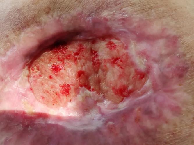 安徽某患者后背创面的肉芽组织,自基底部开始生长,自外缘到内部