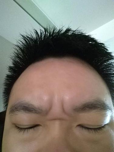 早上起来发现印堂与山根处有个明显的三角纹