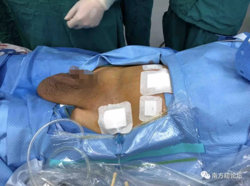 讨论巨大腹股沟阴囊疝4