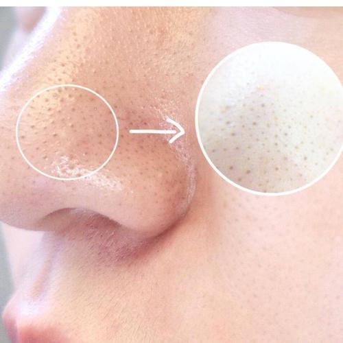 黑头,又叫黑头粉刺,尤其容易出现在鼻子上.