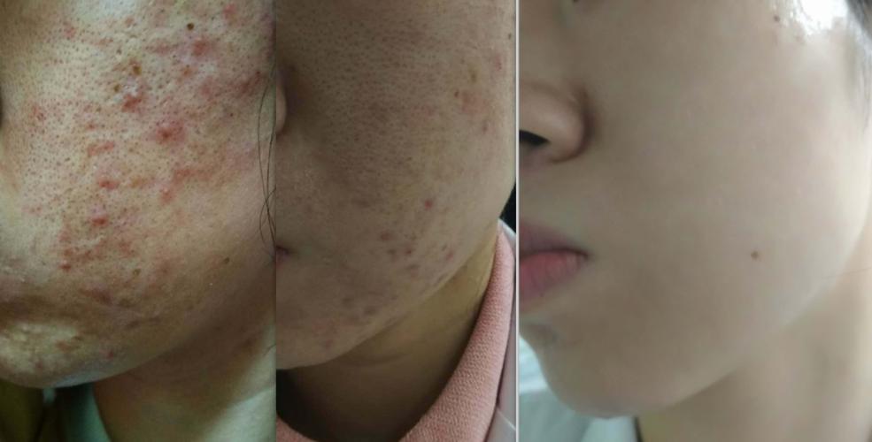 光动力疗法让你的痤疮一扫而光