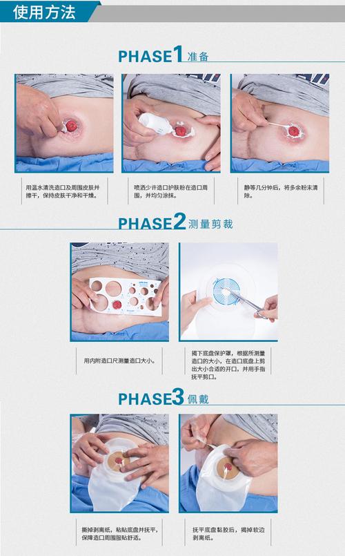 式医用造口袋 人造肛门造口接大便袋结回肠造口一次性肛肠造瘘袋22771