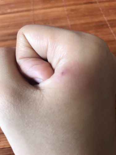 我的手被金丝熊品种的仓鼠咬了,咬过之后,我就用水冲