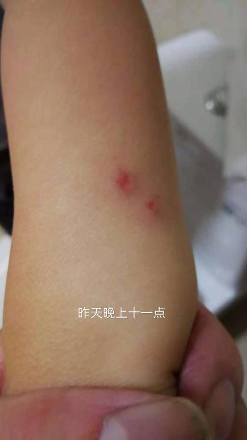 请问被仓鼠咬过的人,看看这个图片是不是被仓鼠咬的,看着不像,但孩子