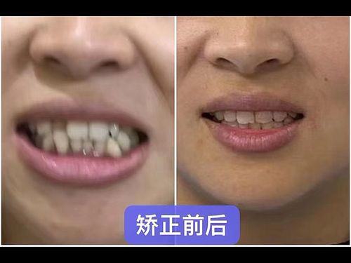 牙齿矫正前后对比效果图