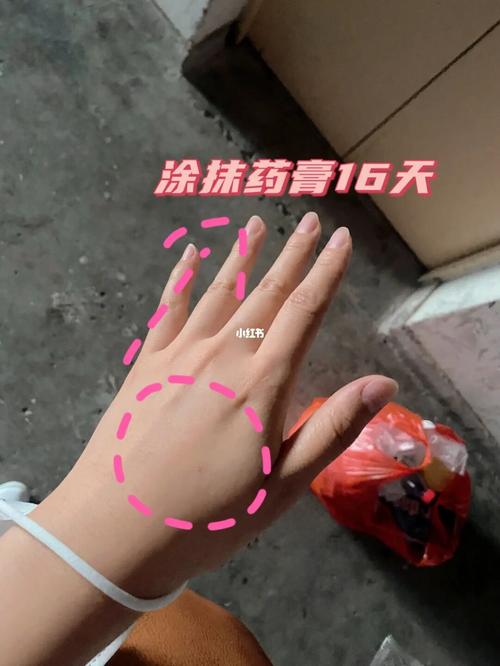 腱鞘囊肿 手背鼓包 教你好办法去除_药膏_腱鞘炎_疤痕