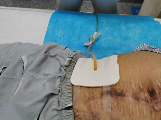 膀胱造瘘术后的护理及注意事项