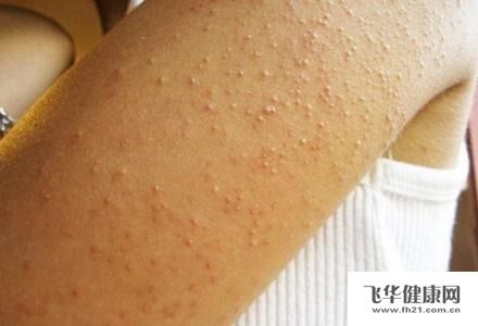 许多患者会将毛囊角化病和鱼鳞病混同起来,因为毕竟二者有许多