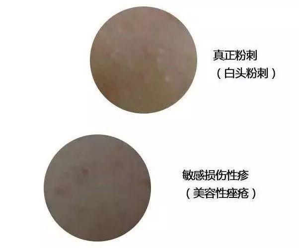 【美丽讲堂】开口闭口粉刺,识别黑头白头……了解这些