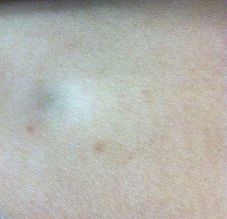 背上有一个包,很久以前觉得这个地方总是长痘痘,后来突然长了一个不疼