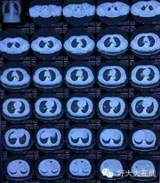 一起来看片~5分钟找到"肺部小结节"