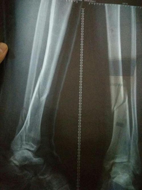 45天拍的片子,肉骨长了骨痂,胫骨没长,还用石膏固定吗?