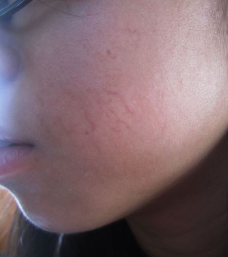 脸上毛细血管明显,是什么问题?