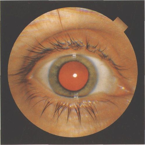 人死后瞳孔变化图片