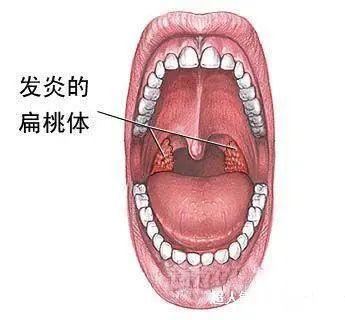 扁桃体总是发炎咋回事啊