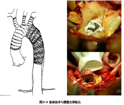 探讨象鼻技术联合血管腔内支架治疗复杂主动脉夹层的手术策略