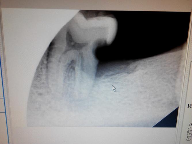 后槽牙一咬东西就疼,去了3次医院,一直未解决,真心求助