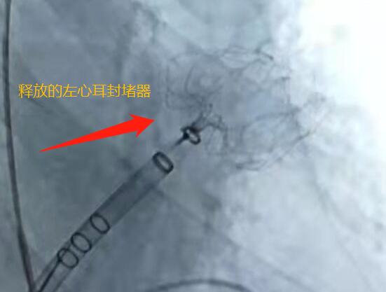 新突破左心耳封堵术德阳市二医院微创介入技术让房颤患者远离卒中