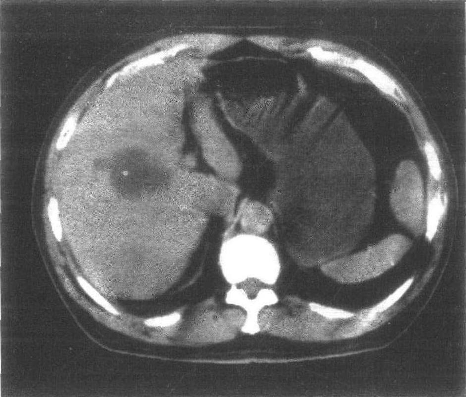 肝囊肿-腹部ct诊断-医学