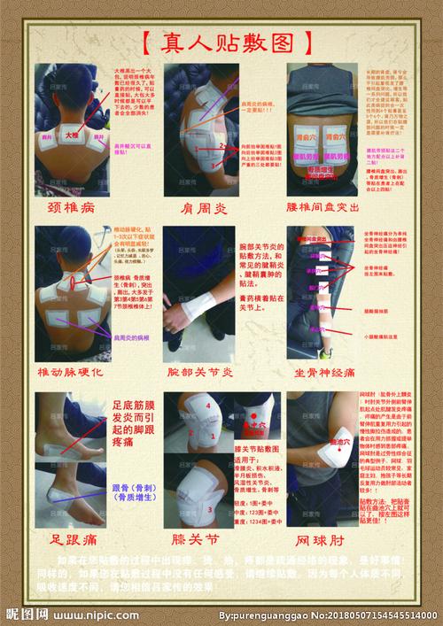 艾灸 膏药 不带二维码真人贴敷图片