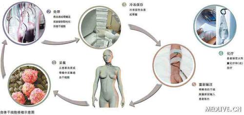 骨髓移植的流程