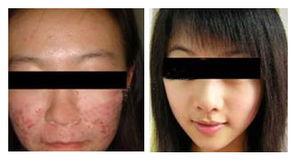      如果您身边也有朋友饱受痘痘的困扰,赶紧让他预约