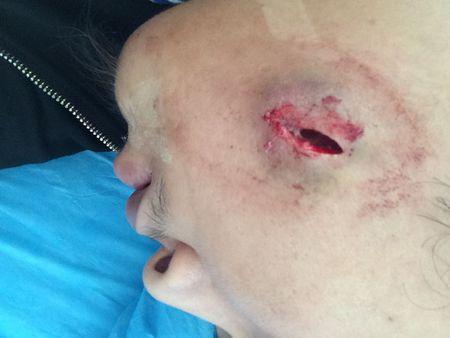 做了面部囊肿引瘤手术,手术后可以吃香蕉,橘子吗,外加