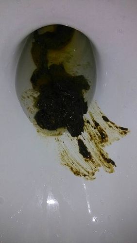 胃癌黑大便图片 (34)