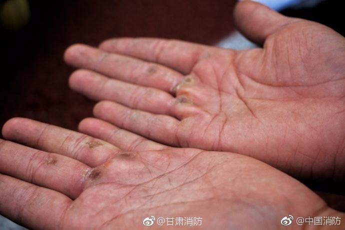 你会为这双手的主人点赞吗?伤痕累累,因为他们是消防员
