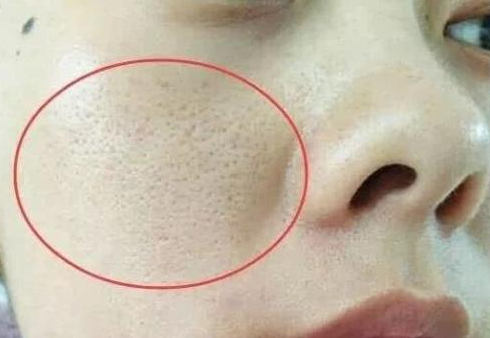脸上毛孔被螨虫"堵住了",有这3个特征,别等烂脸才后悔