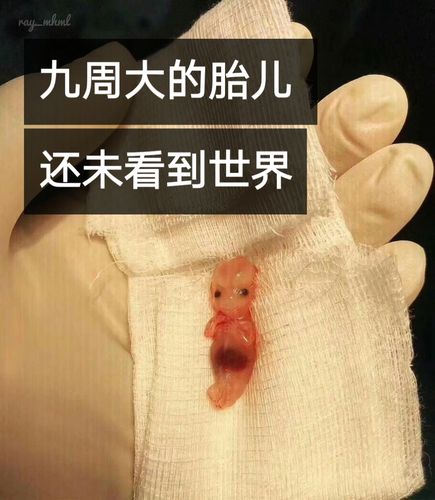 这是一个九周大的胎儿. 还未看到这个世界就被扼杀.