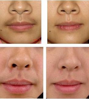 桂林佳美医疗整形门诊部激光脱唇毛术的价格介绍