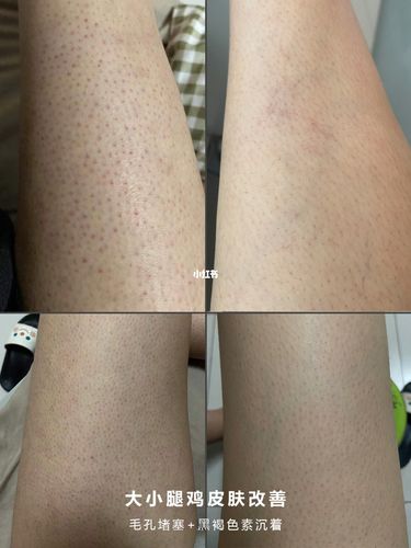 大小腿1个多月的改善_鸡皮肤_毛孔_毛孔粗大_去鸡皮_冷知识_冬天去哪