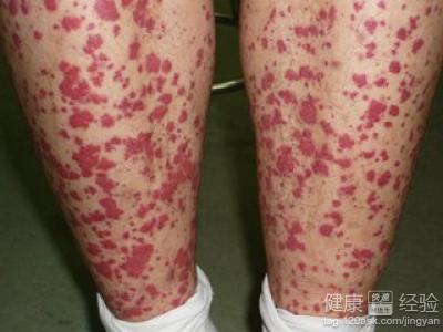 过敏性紫癜会不会痒