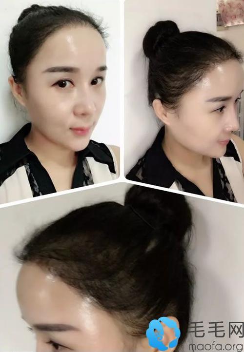 分享我在北京种植发际线2500fu9个月经历及对比照片