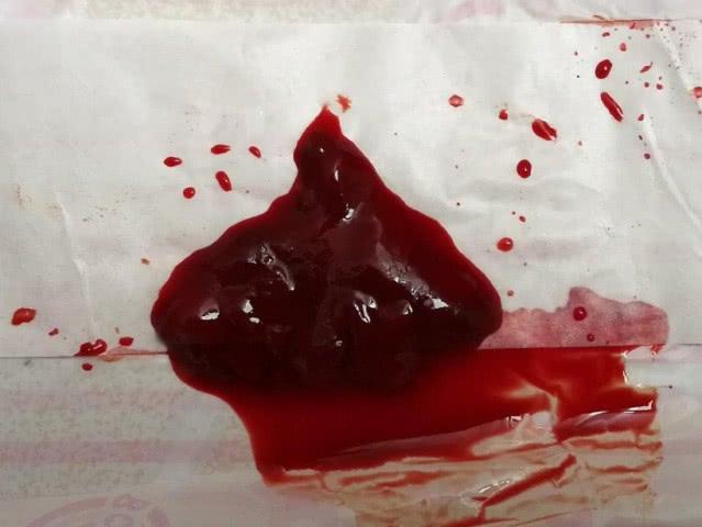 00后女生"例假",竟然排出"肉团"?医生说可能是这3种