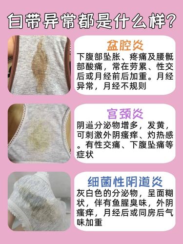 你的白带正常吗?白带异常千万别拖!