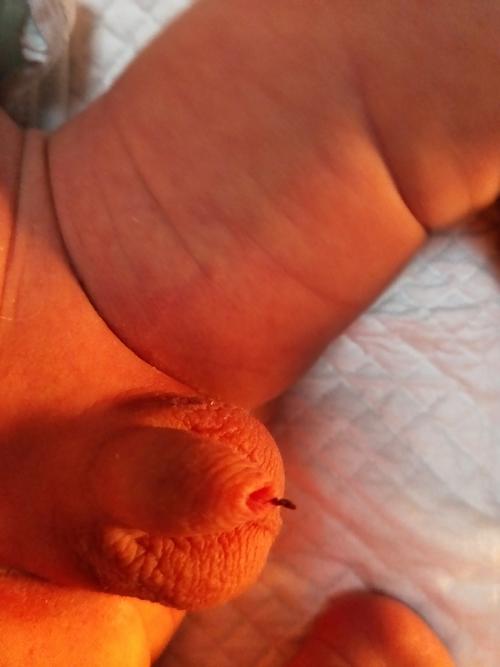 宝宝的jj上有个疤以为是灰 没捏下来是连着的 肚脐也