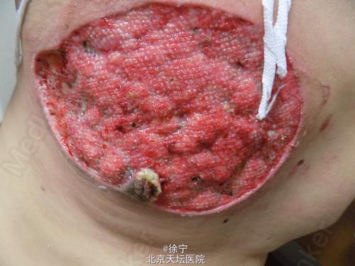 坏疽性脓皮病一例