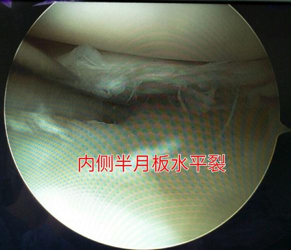 内侧半月板后角至体部明显退行性改变,合并水平撕裂.