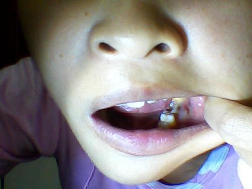 不过根尖炎,尽快去口腔科做根管治疗,将坏死的牙髓去除将牙齿外形补上