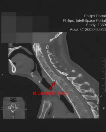 ct检查显示,张先生第七颈椎骨折,脱位,脊髓和神经受压严重.