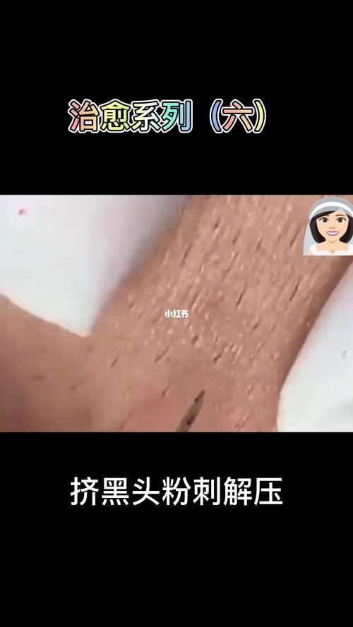 解压视频:挤黑头粉刺_解压_黑头粉刺_解压视频_美妆_护肤_护肤其他