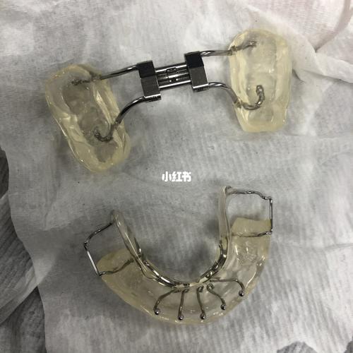 二次正畸 sgtb毕业了_牙齿矫正_牙套_我的正畸之旅_美