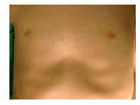 小儿漏斗胸症状的详细讲解