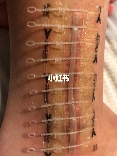 这就要从伤口的愈合规律上来说,可以分为两方面:_疤痕_南加门诊部