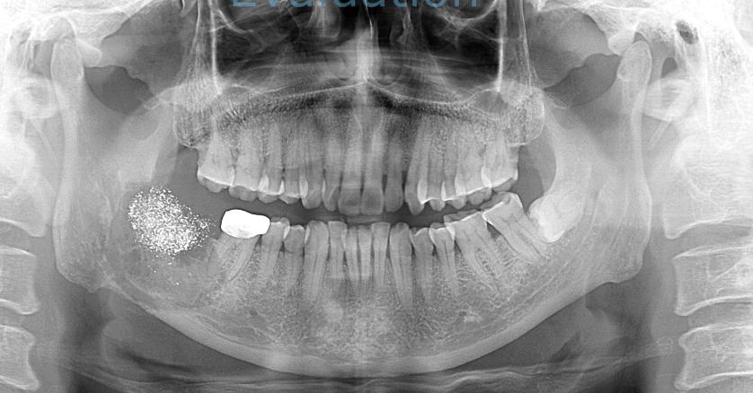 震惊61岁男性患者牙疼竟是肿瘤这些症状一定要注意