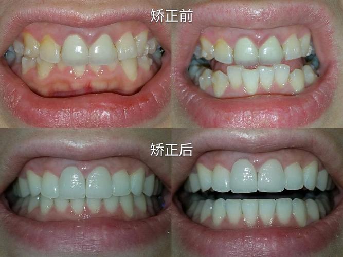 隐形牙套,上海,已毕业,内有对比图
